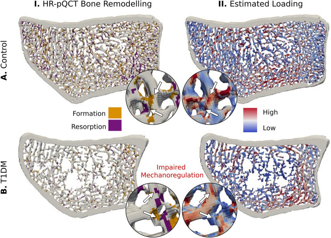 Published comparison of bone remodelling and estimated loading in controls and participants with type 1 diabetes.